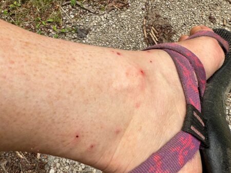 How to Treat Chigger Bites Ankle with multiple red insect bites wearing purple sandal outdoors on gravel path
